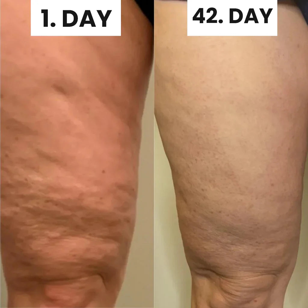 Masseur à ventouses anti-cellulite