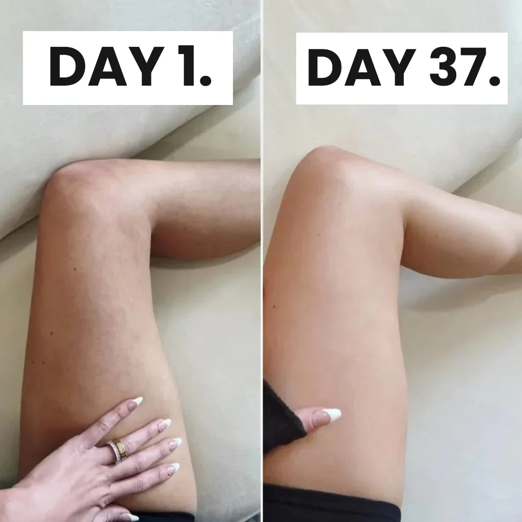 Masseur à ventouses anti-cellulite